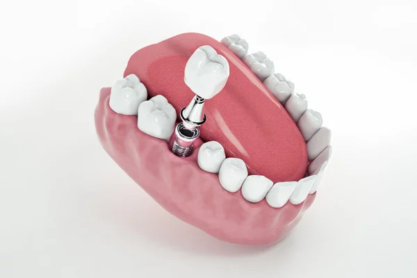 Dental Implants